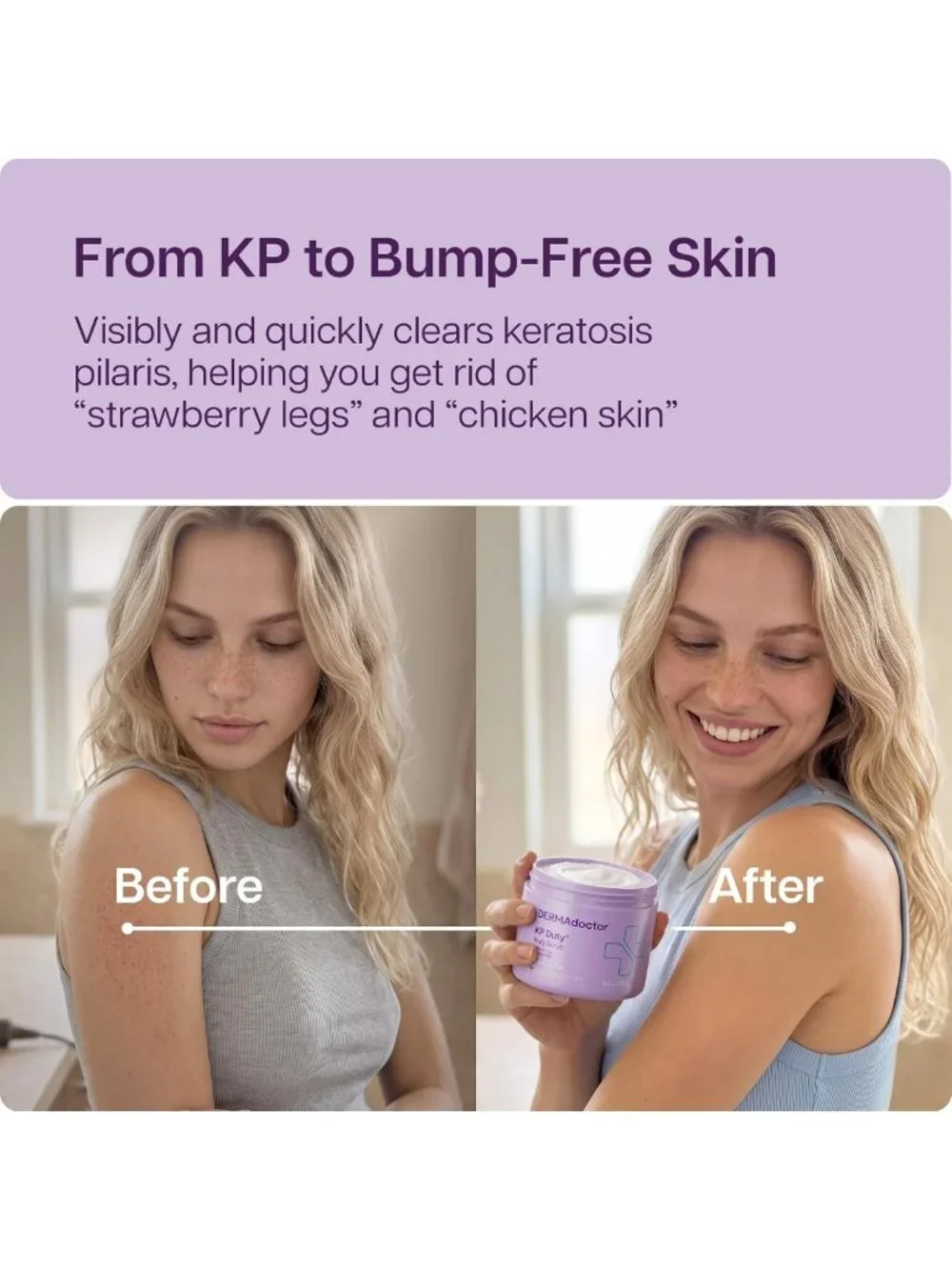 Exfoliating Body Scrub for Keratosis Pilaris | 10% AHAs + PHAs, 16 Fl oz